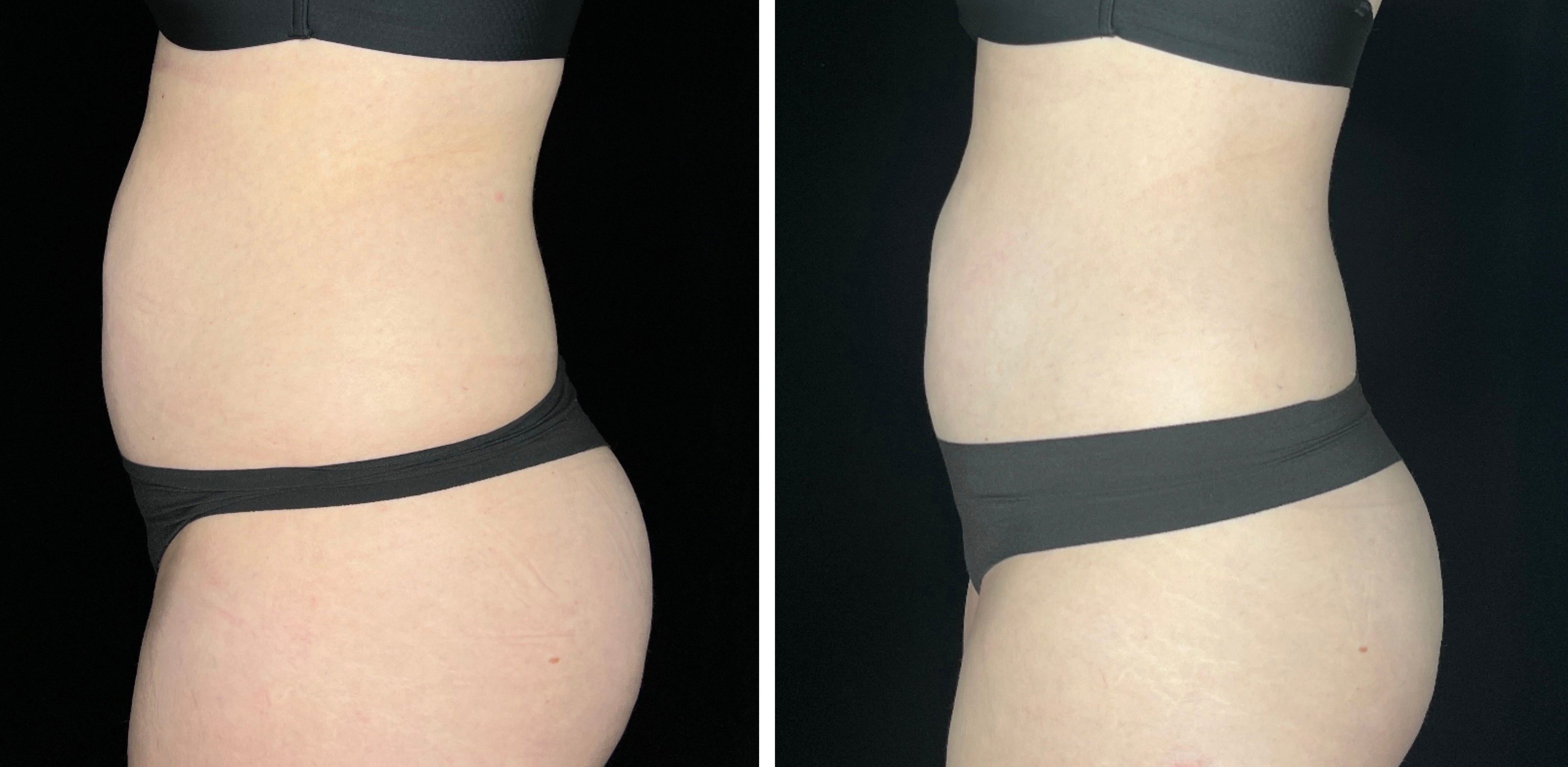 Four Reasons to Include Flirt’s truBody® Technology by Cutera in Your Fitness Routine