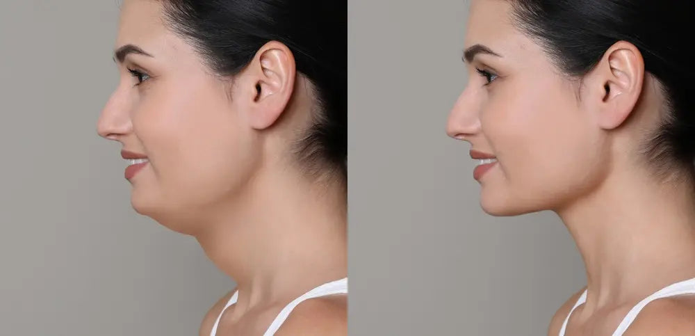 Effective Double Chin Treatments Available at Flirt Cosmetics Studio