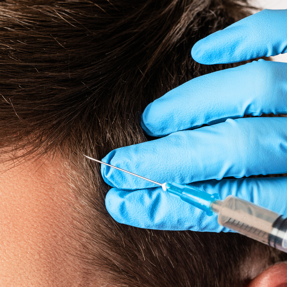 Man getting PRP hair restoration, an additional service at Flirt Eyebrow Bar in Cochrane